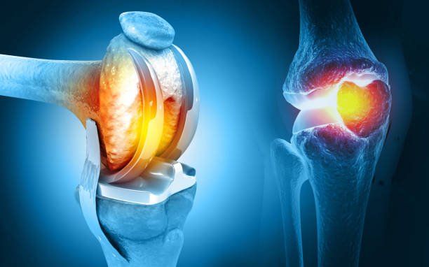 Knee Replacement  Surgery